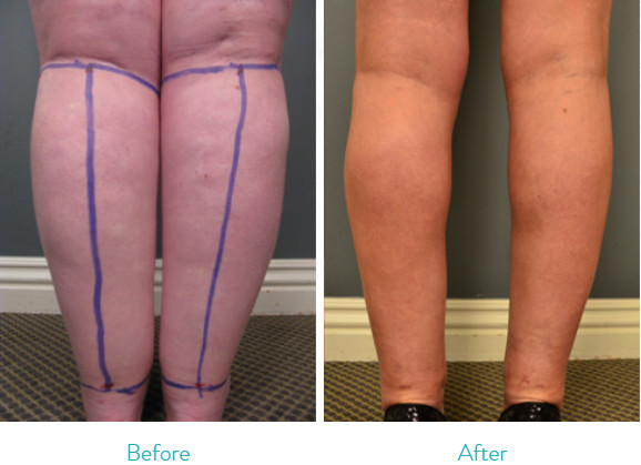 Aesthetics Surgical Liposuction Machine For Calves / Ankles Fat Removal