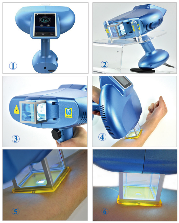 Xecl Vitiligo Excimer Laser Light For Psoriasis Vitiligo Seborrheic Dermatitis