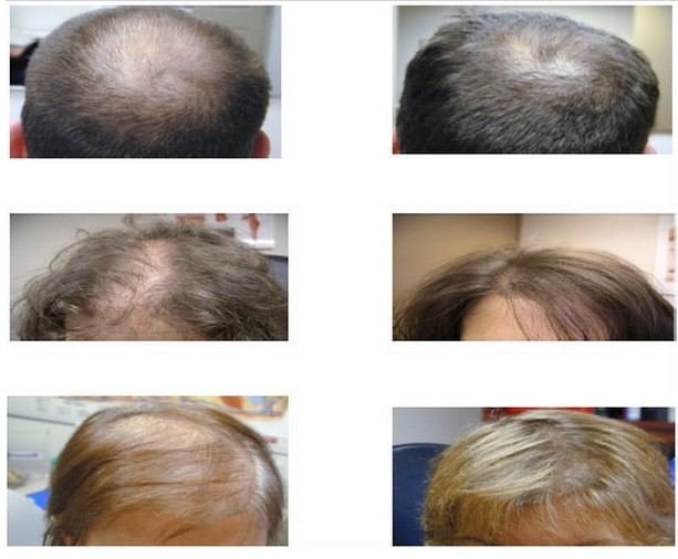 Infrared Hair Regrowth Laser Machine , 650nm Diode Laser Hair Fall Treatment Machine