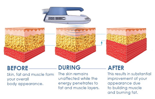 Muscle Build Skin Tightening EMS EMShapeing Machine
