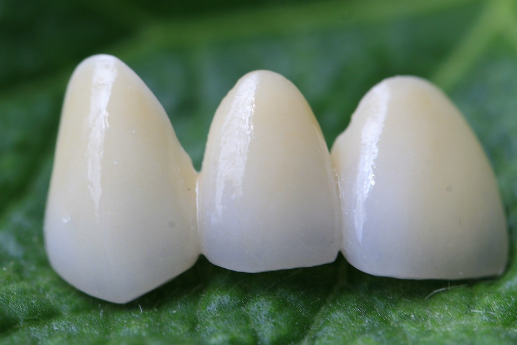 Aesthethics Glass Ceramic EMAX Posterior Crowns For Molars