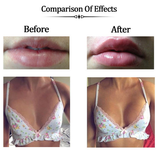 Injectable Hyaluronic Acid Wrinkle Fillers Smooth Outlines Wrinkles Shape Facial Contours Add Lips Volume