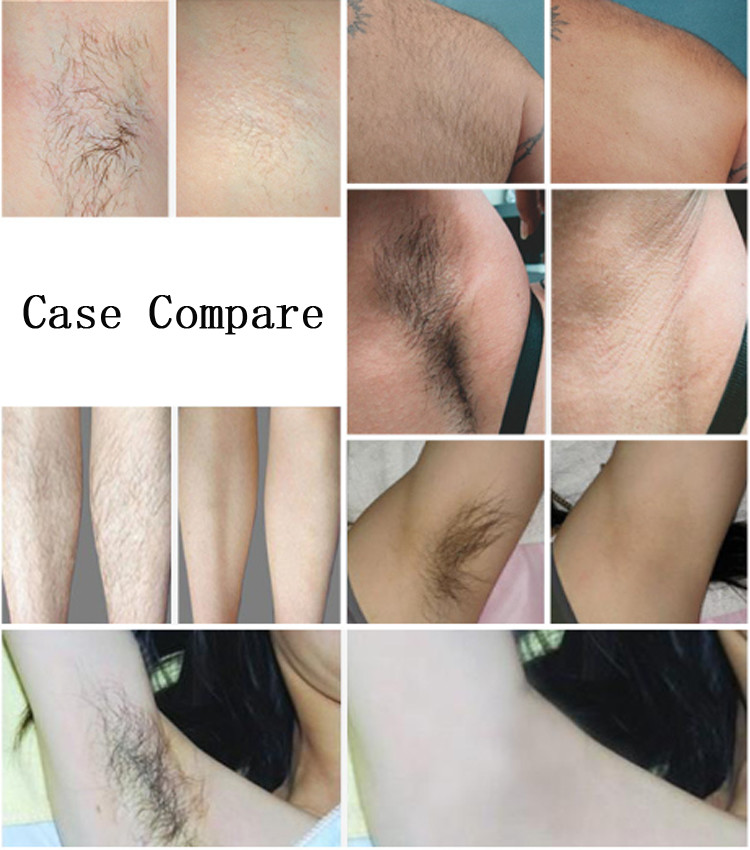 1000W Diode 808 Nm Permanent Hair Removal Equipment 2-88j/Cm2