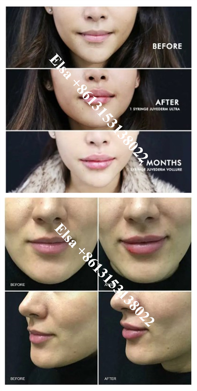 Beauty salon Juvederm Filler Dermal HA Gel Injection For Anti Aging