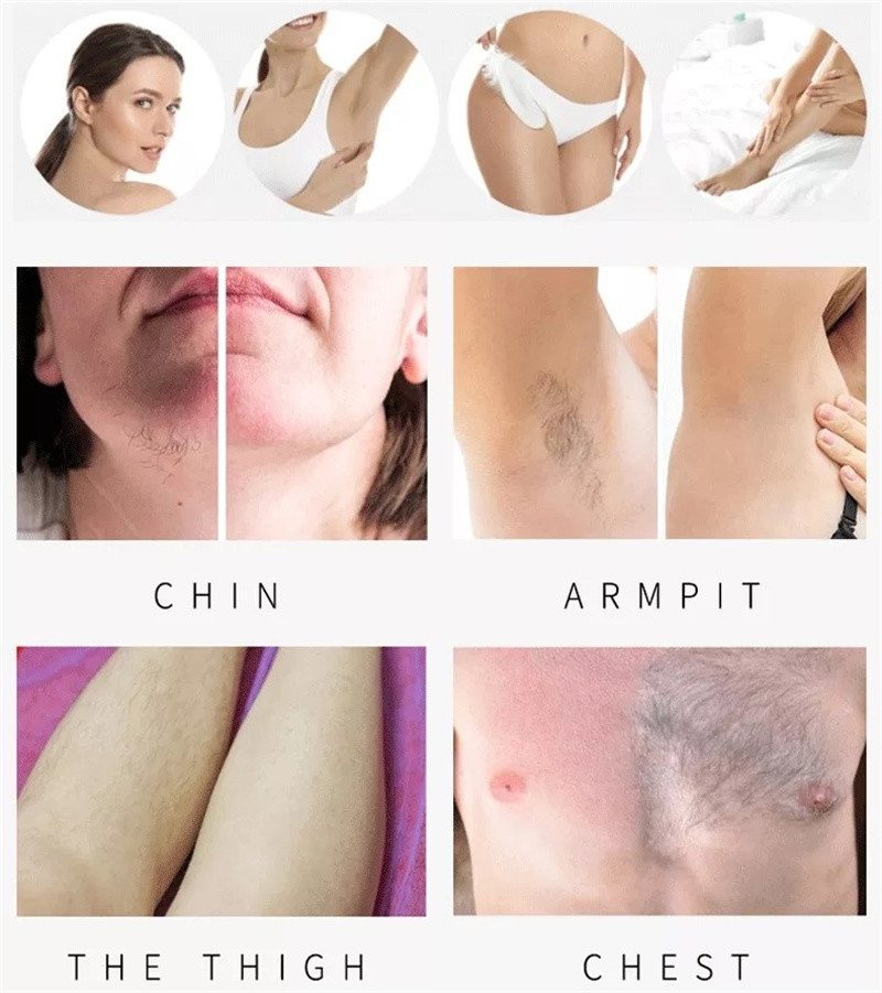 Portable Painless Diode Hair Removal Machine 755nm 1064nm 808nm Permanent