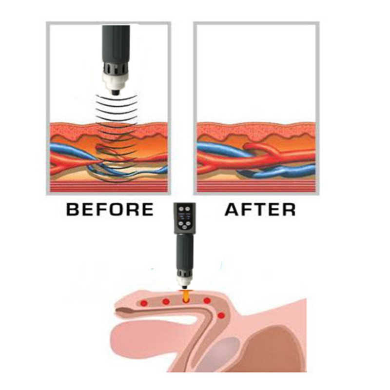 Extracorporeal Shockwave Therapy Machine Erectile Dysfunction Treatment Use