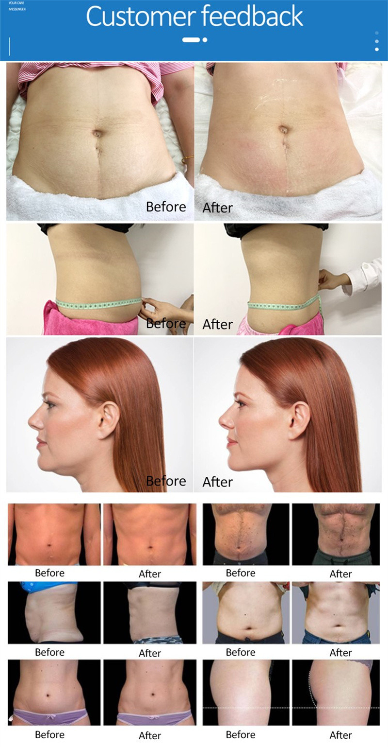 Portable Fat Freezing 360 Cryolipolysis Slimming Machine Dual Handles