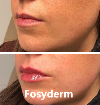 Cross Linked Hyaluronate Acid Dermal Lip Filler 1ml 2ml 10ml Lip Enhancement Injection