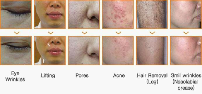HOT !!! 3 in 1 ND YAG laser IPL& RF machine Ht850