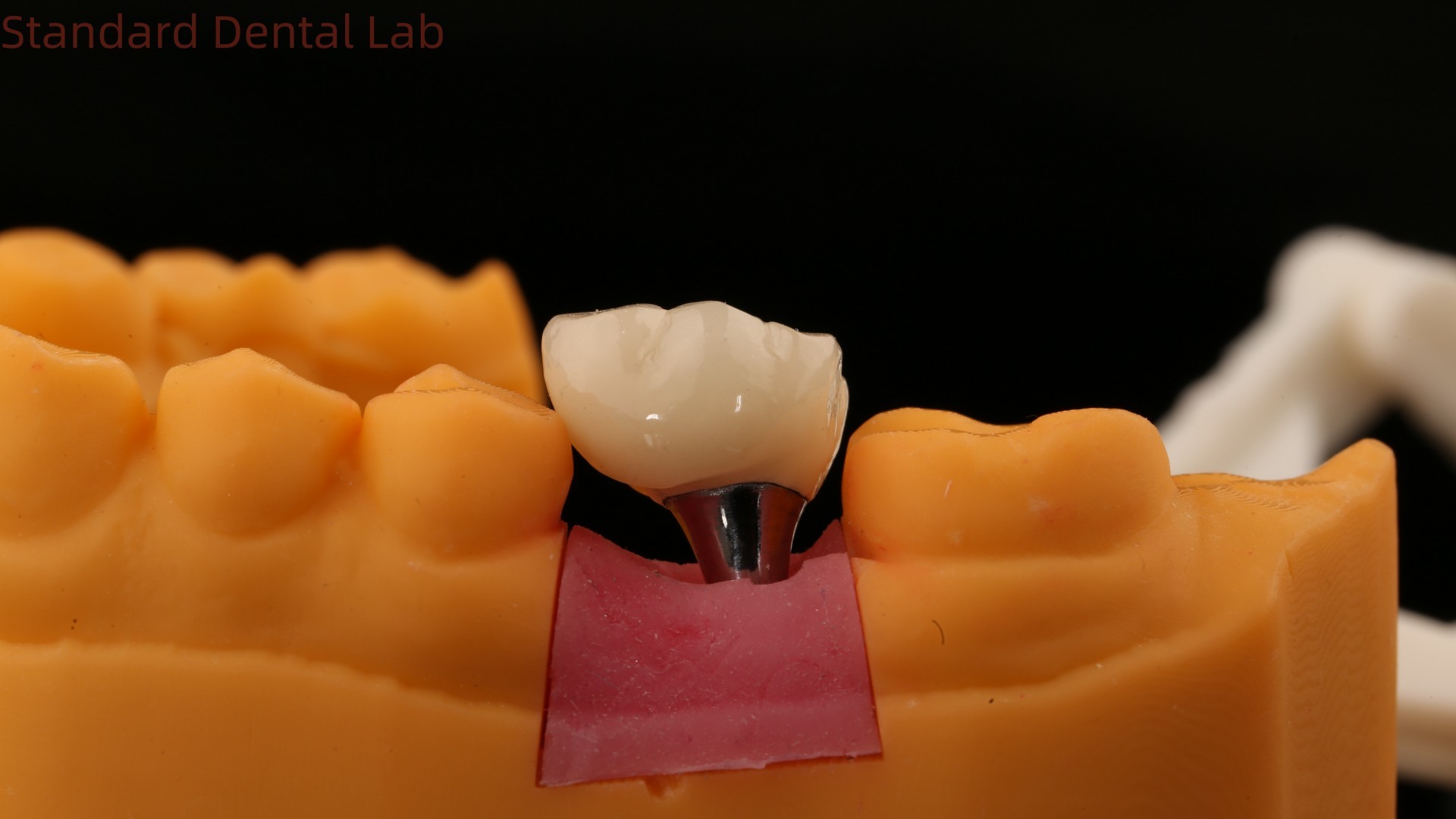 Screw Retained Dental Implant Crown Dental PFM Crown With 3D Print Model