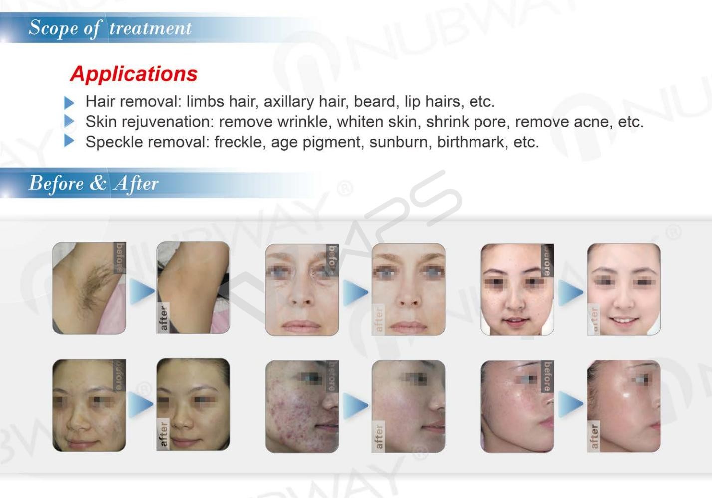 Multifunctional soprano diode laser skin hair removal ipl machine intense pulsed light machine