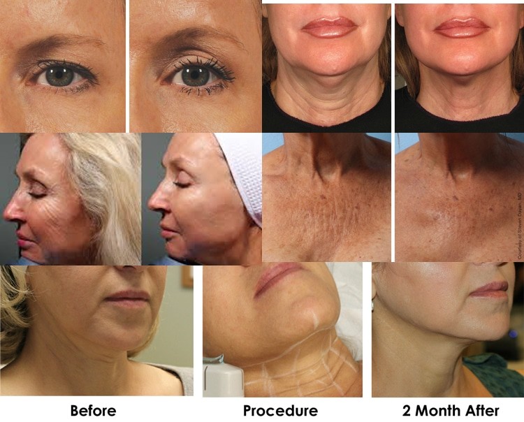 2018 high intensity focused ultrasound hifu,ultrasound hifu,skin tightener,face skin tightening,hifu korea
