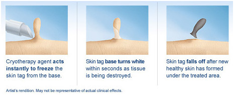 Spider vein laser removal Laser varicose vein removal treatment