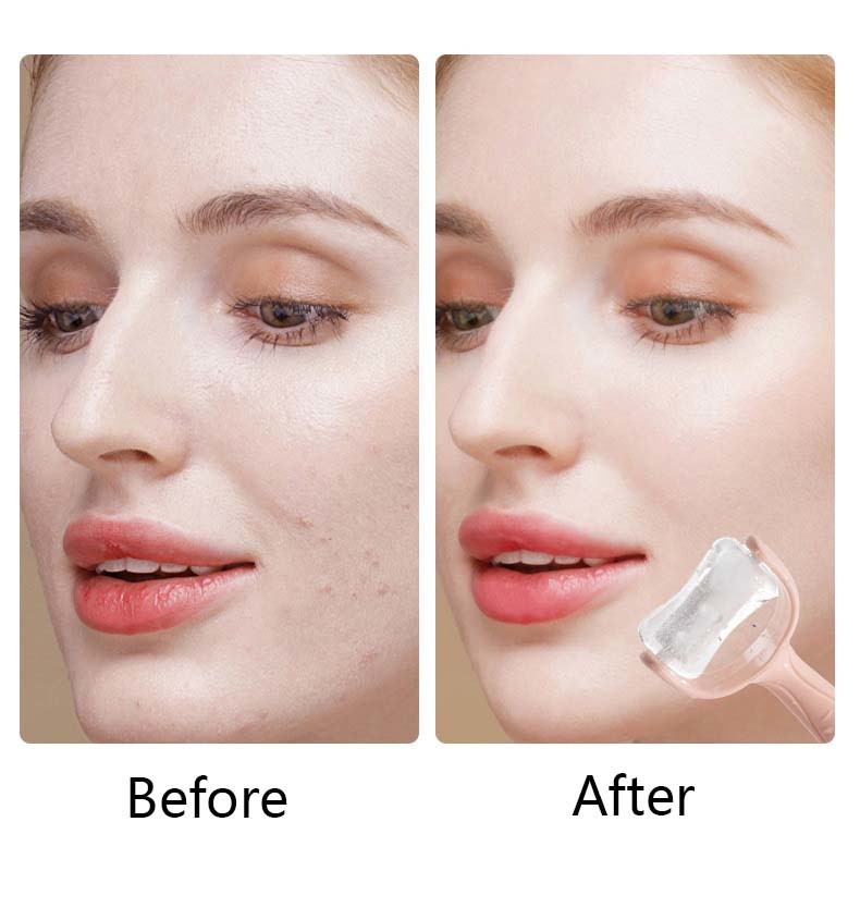 Cryotherapy Ice Roller For Face Eyes Silicone Face Massager Roller Puffiness Migraine Pain Relief And Minor Injury