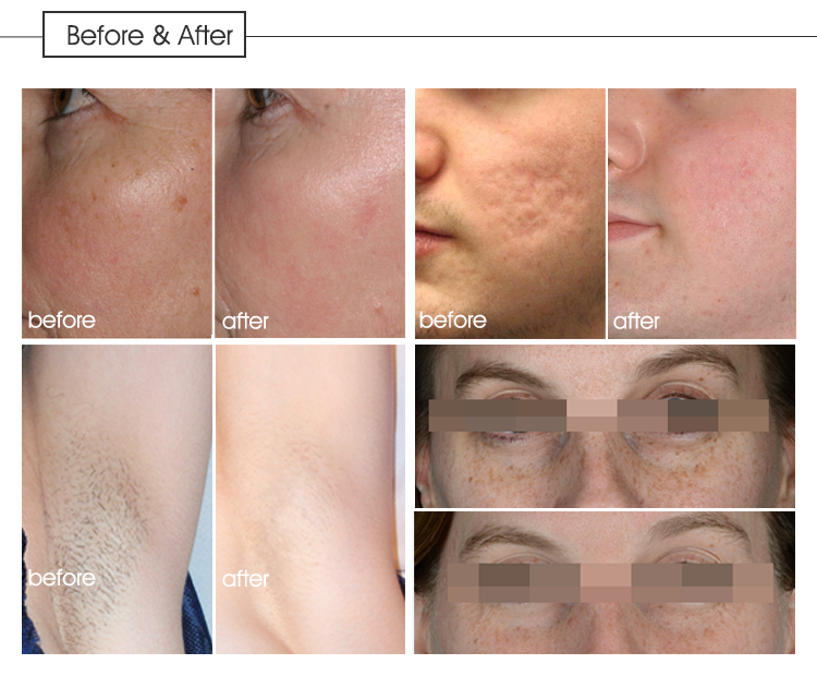 Portable Elight Laser Machine , IPL Hair Removal Machines For Salons