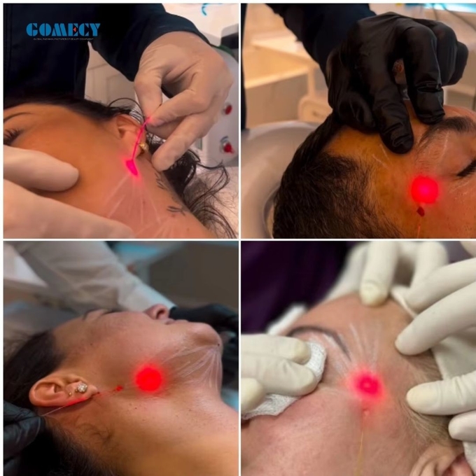 GOMECY 1470nm 980nm/30W Fat Reduction Endolift Laser Device Endolaser Fat Cellulite Reducer Machine