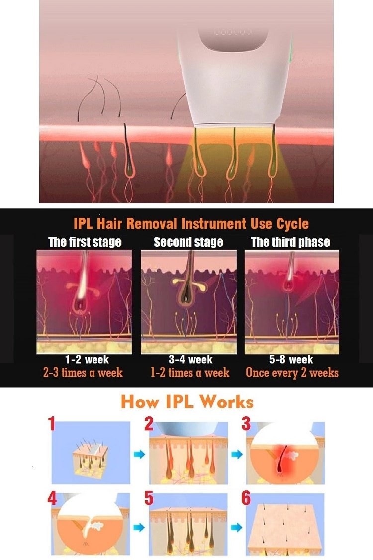 20Min 50HZ 60Hz Full Body Intense Pulsed Light Hair Removal