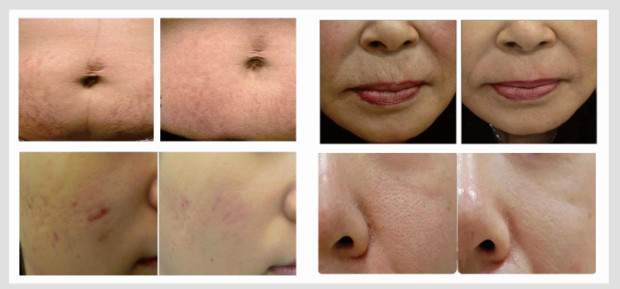 Skin Resurfacing Er Yag Laser Machine Super Penetration Wrinkle Removal Device