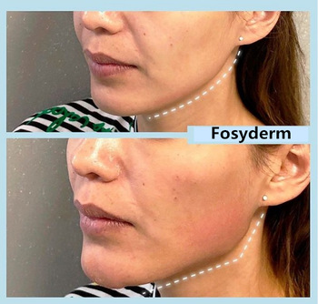 Anti Aging Fosyderm Filler Hyaluronic Acid Syringe Needle Injection