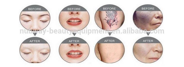best tattoo removal laser machine/q switch nd yag tattooing remover laser equipment