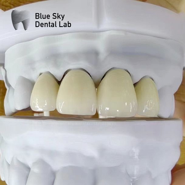 Natural Esthetics Multi Layered Zirconia Crown High Strength Chemical Resistance