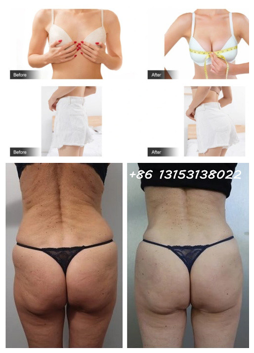 Cross Linked Hyaluronic Acid Dermal Filler For Buttock Enhancement