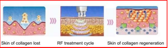Portable equipment Fractional RF microneedle / micro needle skin tightening machine / acne scar removal rf