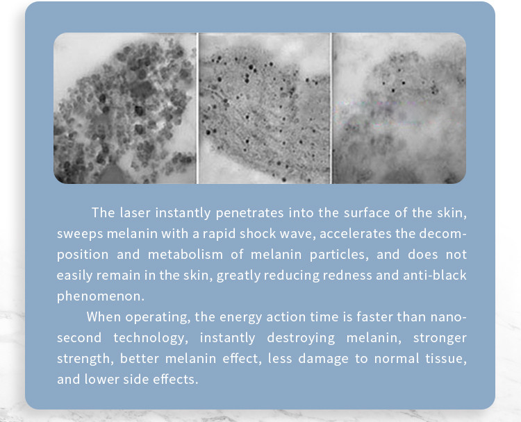 1064 532nm Picosecond Machine Birth Marks Removal