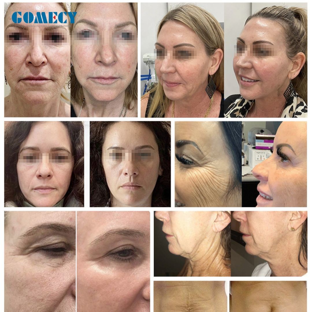 Morpheus 8 Face Lift Beauty Gold Microneedling Machine Skin Rejuvenation For Wrinkle Removal