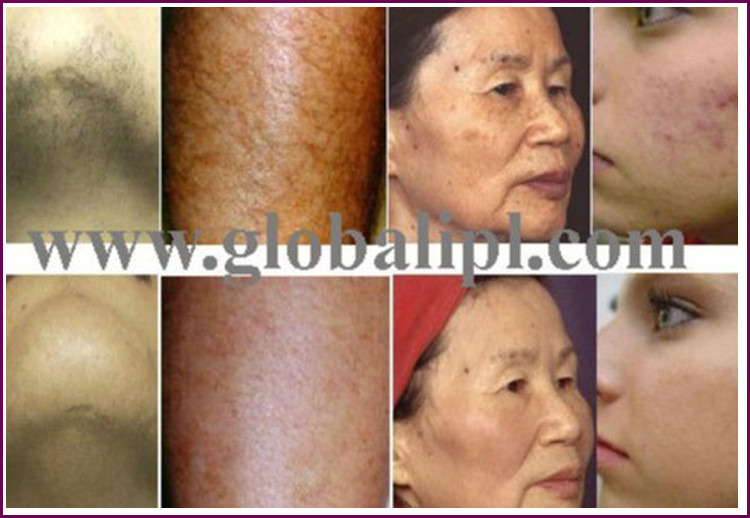 2 System In 1 IPL Diode Laser Machine 10.4 inch With 2 Handlepieces Beuaty Equipment