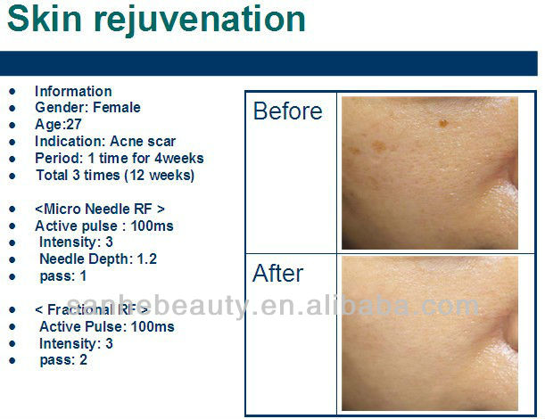 skin lifting machine fractional micro needles RF