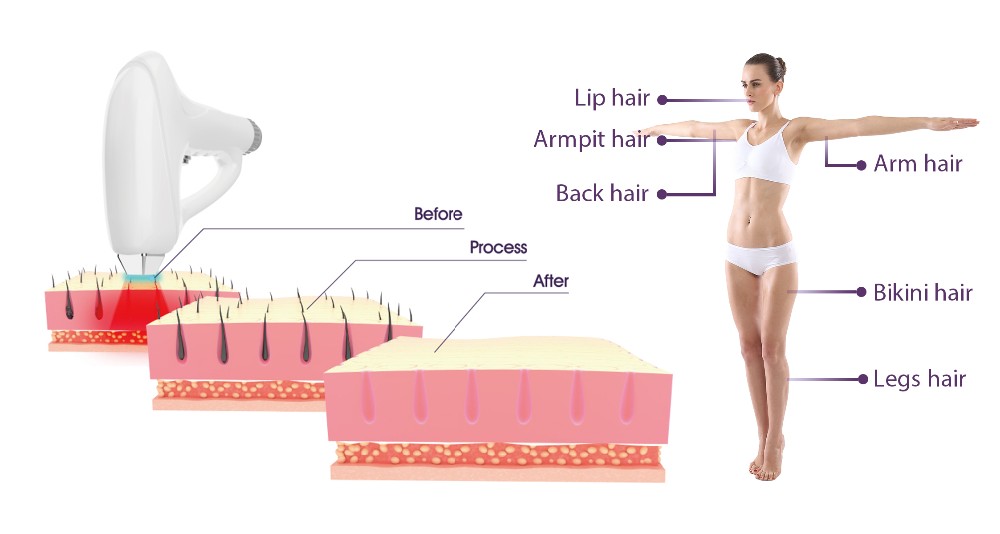 Large Spot Size Laser Hair Removal Equipment Professional High Powerful
