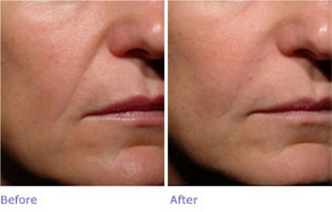 No Pian Oxygen Jet Peel Machine PDT Jet Peel For Skin Treatment