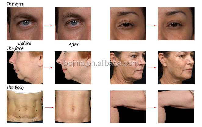 Commercial Radio Frequency Fat Melting Machine For Face / Skin Tightening