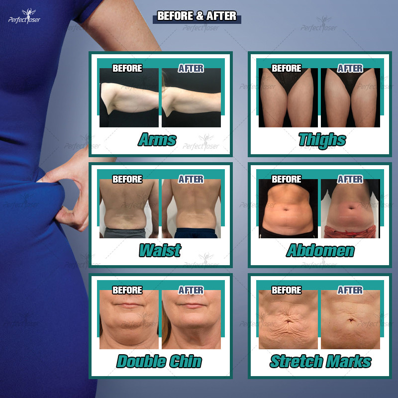 Advanced Fat Freezing Body Sculpting Machine with Cooling Temperature c and RF Energy