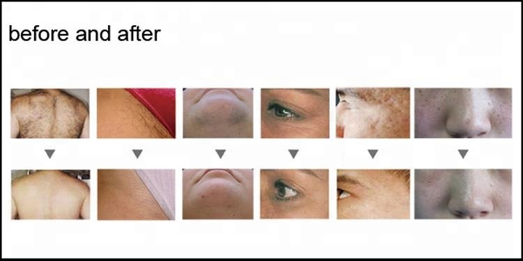 CE DPL Laser Machine Skin Rejuvenation Acne Pigmentation Treatment Machine