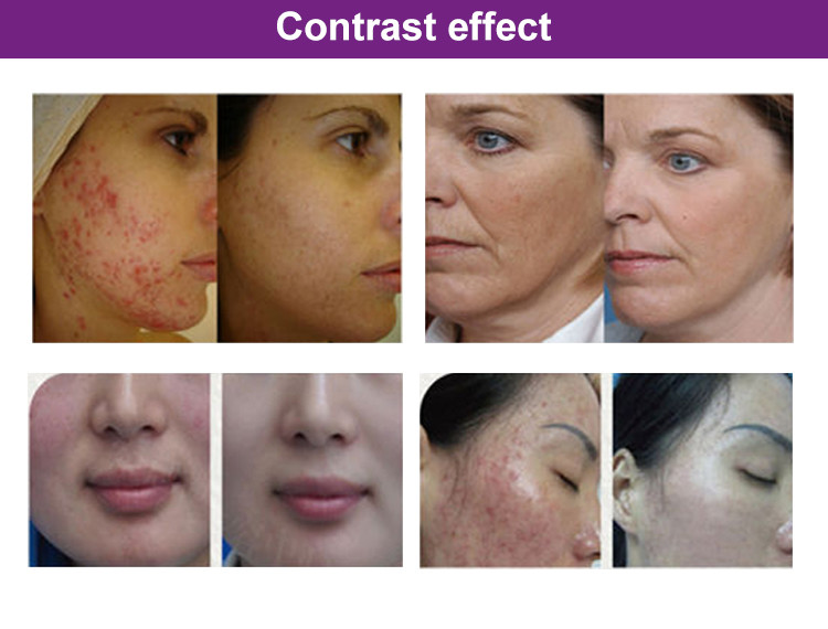 Pdt Light Therapy LED Therapy Equipment For Acne Treatment And Skin Whitening&Tightening