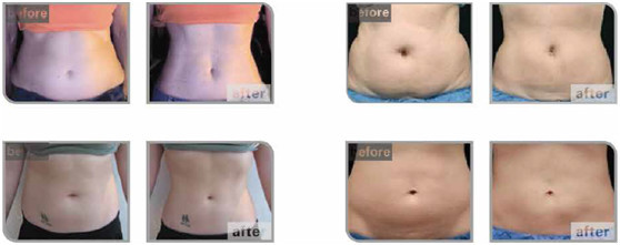 hifu slimming treatment before and after.jpg