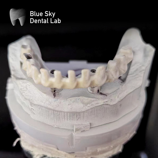 Titanium Frame Malo Bridge Dental Custom Malo Implant Bridge