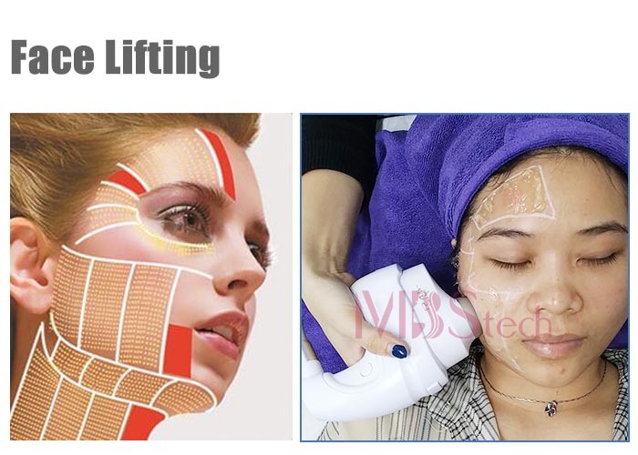 Fda Approval 5D ICE Ultrasonic Hifu For Skin Tightening