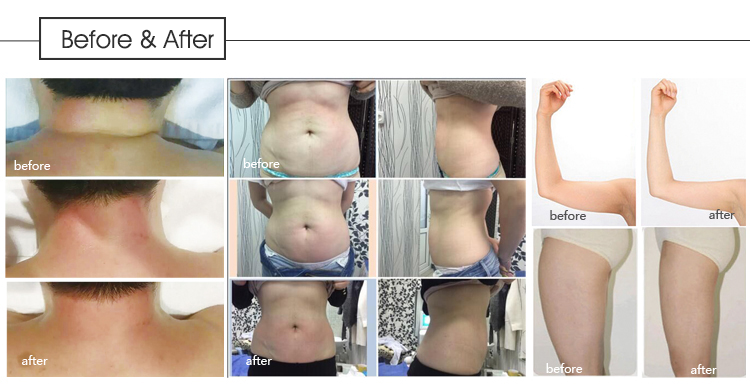 Vela Slimming Machine Vacuum RF Ultrasonic Cavitation Machine