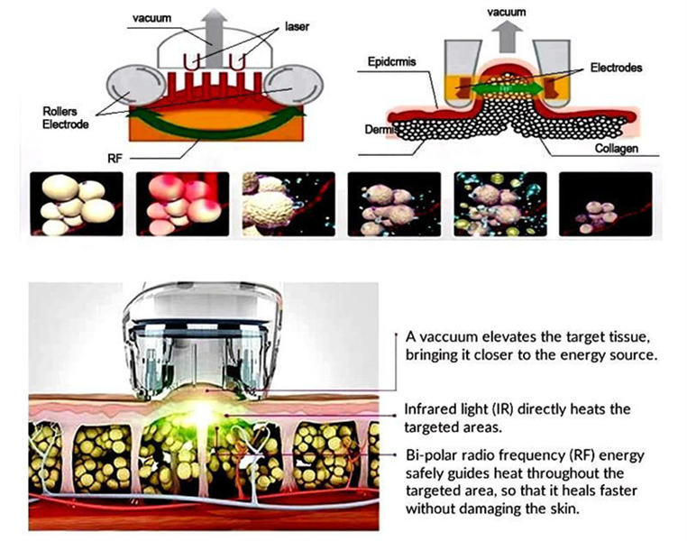1MHZ To 5MHz V9 Vacuum Cavitation Machine Skin Tightening Face Body