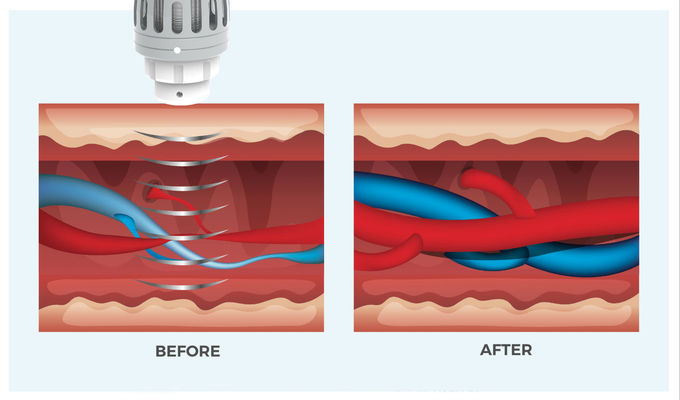 Erectile Dysfcunction Shock Wave ESWT Therapy Machine