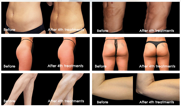Non Invasive Aesthetics 4 Handles Ems Device Build Muscle Burn Fat Body Slimming