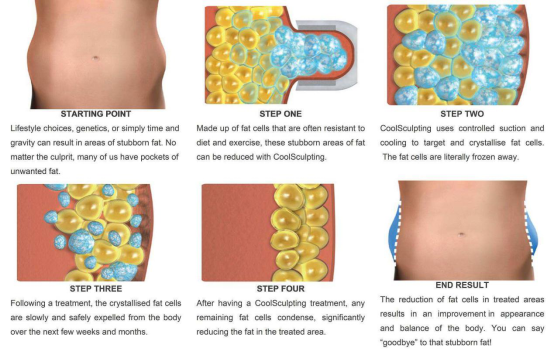 cryolipolysis-weight-Loss-4-handles-fat-slimming .png