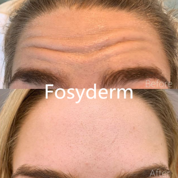 HA Cross Linked Hyaluronic Acid Wrinkle Fillers Injections For Deep Face Wrinkles
