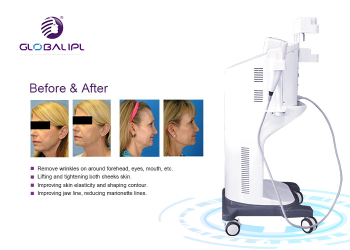Ultrasound Face Lifting HIFU Machine 25000 Shots Self Developed Patent Technology
