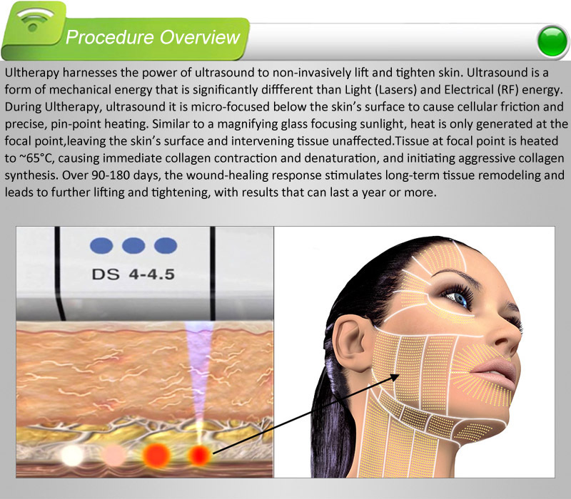 Hifu machine, 2014 New HIFU, , Non-invasive wrinkle removal and skin lift