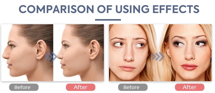 Original Korea Revolax Dermal Filler Cross Linked Hyaluronic Acid Injection 24mg/Ml