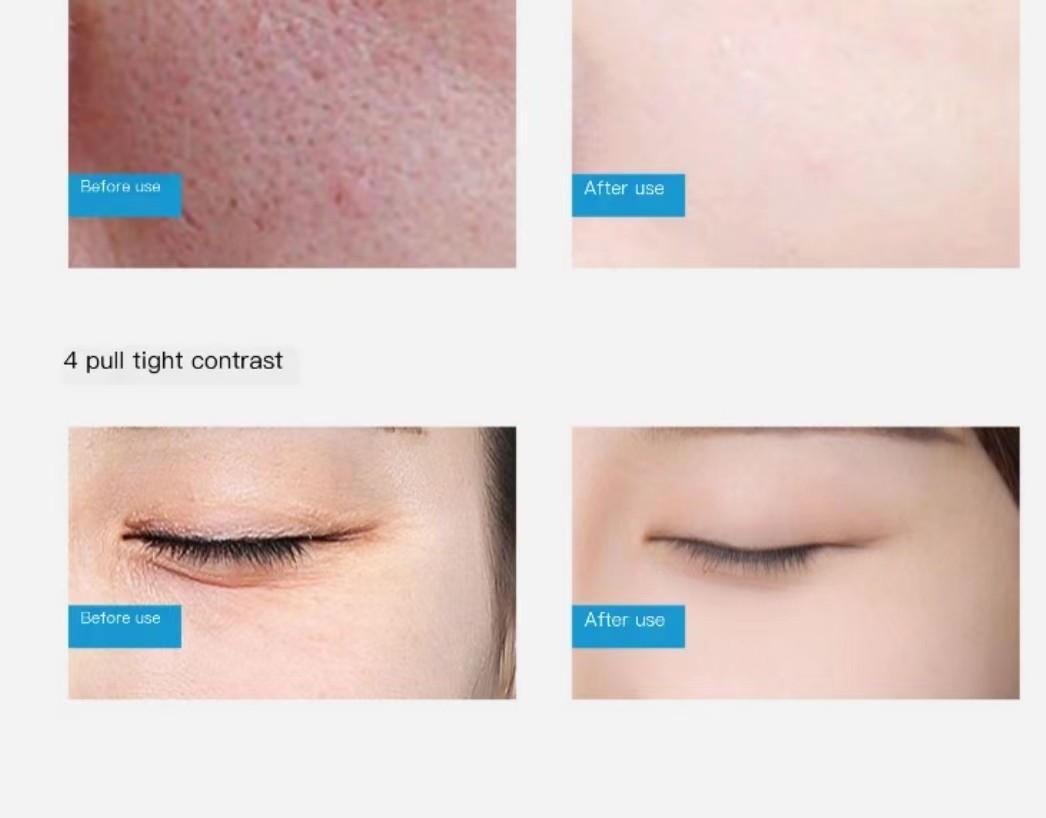 Blackhead Remover Hydra Beauty Machine Facial Skin Aqua Deep Cleaning 14 In 1